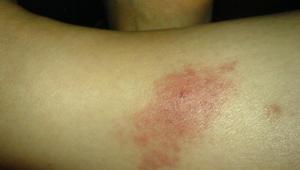 Adana, İzmir ve Ankarada görüldü Korkutan salgın uyarısı Adana, İzmir ve Ankarada görüldü Korkutan salgın uyarısı