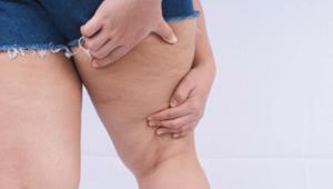 Kadınların gizli düşmanı: Lipödem