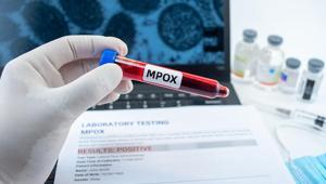 Nijeryada, M çiçeği salgınına karşı aşılama kampanyası başlatıldı