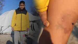 Kuduz köpeğin saldırdığı çocuk: Hiç havlamadan ayağıma atladı ve ısırdı