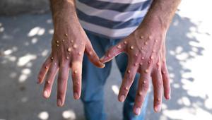 Ganada 34 M-çiçeği vakası tespit edildi