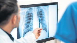 Sigara içmeyen de akciğer kanseri