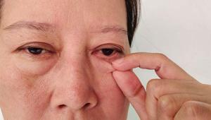 Gözde kızarıklık ve yanmaya neden oluyor Görme kayıpları yaşanabiliyor