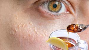 Yüzdeki yağ bezelerine bal-limon darbesi Operasyona gerek yok, 2 kez süren yaşadı