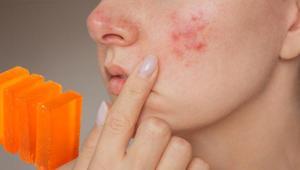 Sivilcem geçti ama iz kaldı diyenlere müjde Kojik sabunu lekeleri silip süpürüyor