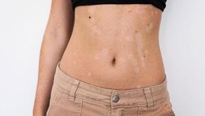 Yazın sessiz misafiri: Tinea versikolor Güneş lekesiyle karıştırmayın