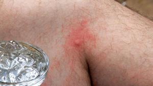 Isırık izini bir çırpıda geçiren yöntem Ne kaşıntı kalıyor ne kızarıklık, jeli şifaymış