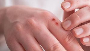 Her yaraya ayrı müdahale gerekiyor Kritik süre 2 hafta, yoksa sonu kötü olabilir