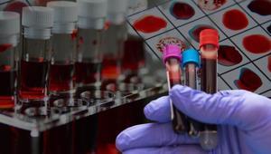 Dünyada sadece 50 kişide var Altın kan laboratuvarda üretilebilecek mi