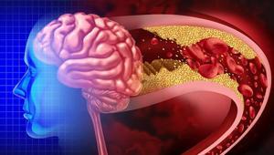 İnme sonrası hayata yeniden başlayanlar anlattı Milattan önce ve sonrası gibi