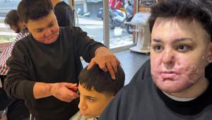 Hayatı birkaç saniye içinde kabusa döndü15 yaşında 8 ayda 65 ameliyat geçirdi: Babamdan özür diledim