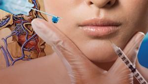 Dolgu ve botoksun karanlık yüzü Sorun kimyasal değil iğne mi ‘Görme kaybının dönüşü yok’