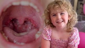 Bademcik ameliyatı 5 yaşındaki kızı hayattan kopardı Ölümün ardındaki tek gece detayı