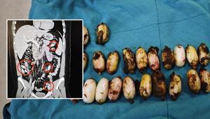 44 kapsül bonzaiyi midesinde saklamış Cerrahi müdahale ile çıkarıldı