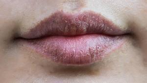 Kış aylarının can yakan sorunu 1 damlası yetiyor, dudakları pamuk gibi yapıyor