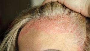 Egzama ile mücadelenin en doğal yolu Bütün dünya bu tarifi konuşuyor