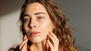 Akne, ‘nasılsa geçer’ deyip ihmal ediliyor Geciken tedavi yüzde kalıcı izler bırakıyor