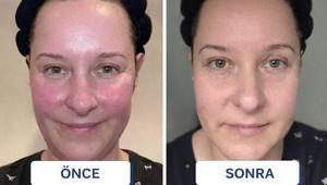 Öbek öbek çıkıyordu Cilt kızarıklığı için tek hamle: 2 hafta bu serumu sürdüm