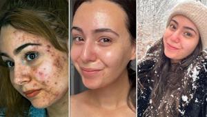 İrin akan sivilcelerinden kurtuldu Çözümü çok basit: İçeriği bu asitle dolu