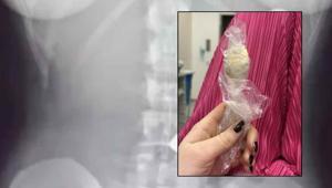 Yoğurt yerken bir anda oldu, söylemeye dahi utandı Tam 17 santimetre büyüklüğünde, 2 gün vücudunda kaldı