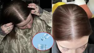 Genç yaşta saçları döküldü Gürleştiren taktiği buldu: Yağsız kullandım