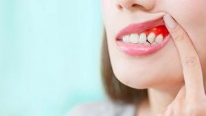 ‘Diş eti hastalıkları kalp ve damar sağlığını olumsuz etkiliyor’