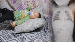 Bebeğin içinde ilerliyordu 1 yıl boyunca ağladı: Tomografide korkunç gerçek