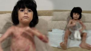 Yaraları tüm vücudunu sardı 4 yıldır mücadele ediyor: Çaresiz durumda