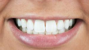 Dişlerdeki sararmalara son Muz kabuğundan gelen mucize