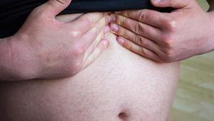 Her 5 kişiden birinin sorunu Dev karın fıtığı hayatı kabusa çeviriyor