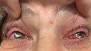 Kızının önerisiyle gözüne damlattı hayatı karardı ‘Sosyal medyada çok yaygınlaşmaya başladı’