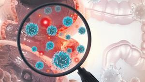 Türkiye’de her yıl 22 bin kişi kolon kanseri oluyor