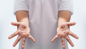 Çocuklarda hızla bulaşıyor Ağız yaraları ve döküntülerle geliyor: Hafife almayın