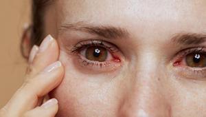 Bahar aylarında göz şikayetlerini hafife almayın Kalıcı hasara neden oluyor