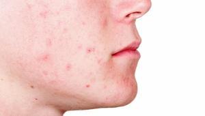 3 ürünle doğal maske Aknelerle mücadelede yeni trend