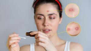 Cilt lekelerine ameliyatsız çözüm Daha dolgun görünüyor, kırışıklıktan eser yok