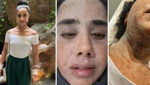 Egzama tedavisinden sonra cildi fil derisine döndü Kremi bırakınca yatağa bağımlı hale geldi