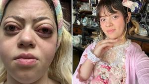 Gözleri birden bire kocaman oldu Sebebi troid bezinde saklıymış