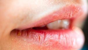 Ağız ve dudaktaki yaraları hafife almayın Ciddi hastalıkların belirtisi olabilir