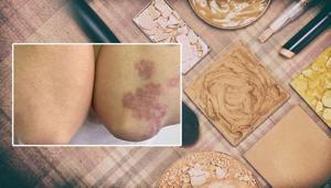 Popüler makyaj trendi ölümüne sebep oluyordu Tüm vücudunu sardı