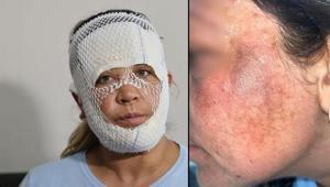 7 bin liralık ‘Prenses cilt bakımı’ kabusu: Oğlum beni görünce öcü diyerek kaçtı