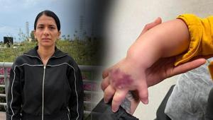 Doktor ‘bir şeyi yok’ dedi Her şey morarmayla başladı: Çocuğumun kolu dirseğe kadar açıldı