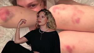 Farah Zeynep Abdullah’tan endişelendiren paylaşım Vücudundaki morluklar korkuttu
