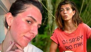 Survivor Merve Aydın’ın değişimi şaşırttı Yüzüne yaptırdığı işlemi tek tek anlattı