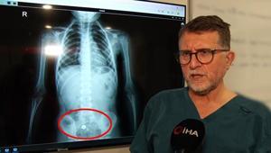Parkta buldu, şeker diye yuttu 4 yaşında çocuğu ölümden döndüren süreç röntgen filminde: Hareket halinde