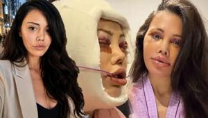 Didem Ceran 15 saatlik operasyonla yüz nakli olmuştu Kendisini dünyaca ünlü yıldızla karşılaştırdı