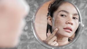 Kahverengi güneş lekesini silgi gibi silsin C vitaminine yeni alternatif