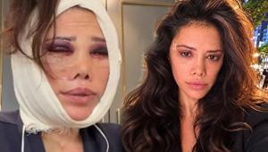 İki kez yüzünü gerdirdi Didem Ceran’dan yeni estetik açıklaması