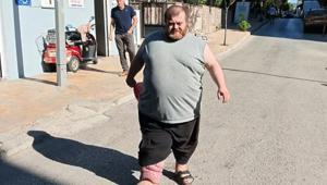 4 yıldır fil hastalığıyla mücadele ediyor Yürümek için 82 kilo vermesi gerekiyor
