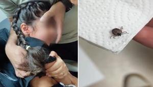 Bir aydır kulak ağrısı çekiyordu Kulağında canlı kene bulundu